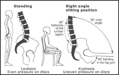Image of Lordosis vs. Kyphosis